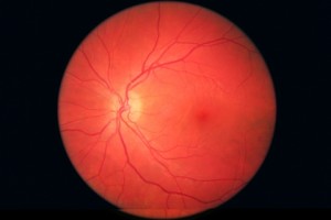 Carleen's left eye