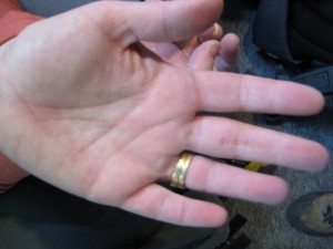 Painful hands